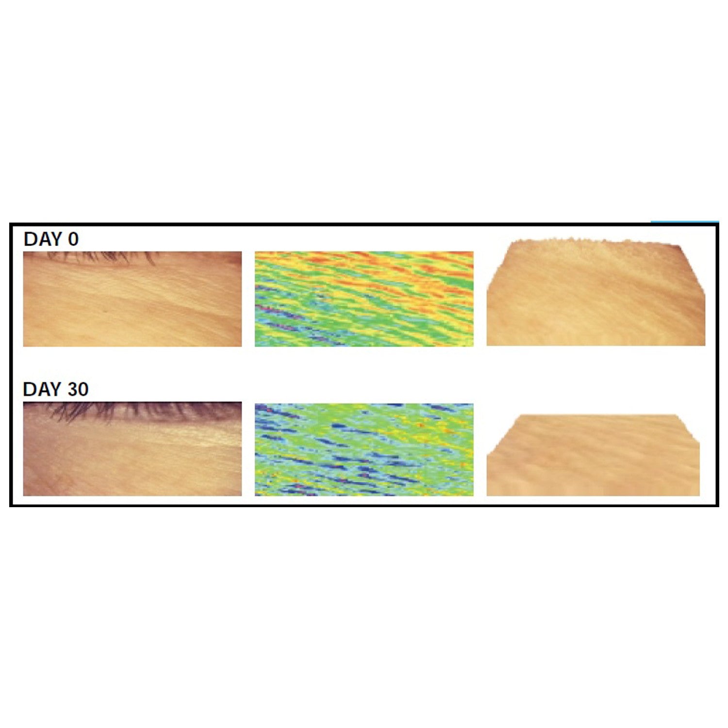 Argireline® an alternative to Botulinum Toxin A